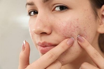 Research finds how fat cells in skin help fight acne