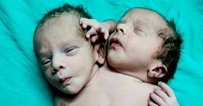 Baby born with two heads, three hands and two hearts after mum told to expect twins
