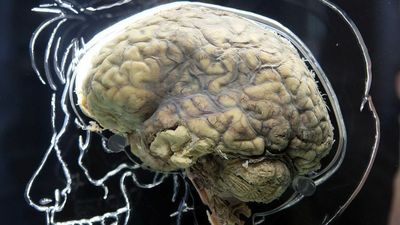 Stroke Of Genius: Electric Brain Shocks Could Help Stroke Patients Recover, Say Scientists