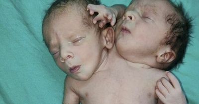 Doctors stunned as miracle baby born with two heads, three hands and two hearts