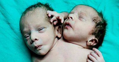 Baby born with two heads after first-time parents told they were expecting twins