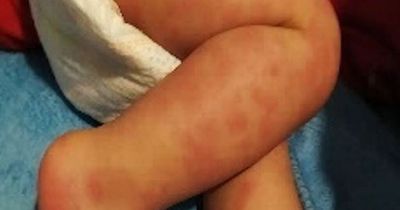 Parents warned of severe rash that can hit toddlers who have Covid