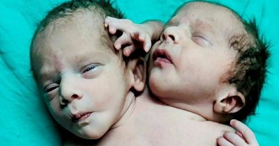 Baby miraculously born with two heads after parents told they were expecting twins