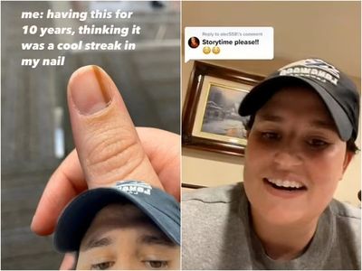 Woman tells how ‘cool streak’ on her fingernail led to rare cancer diagnosis: ‘I just figured it was a mole’