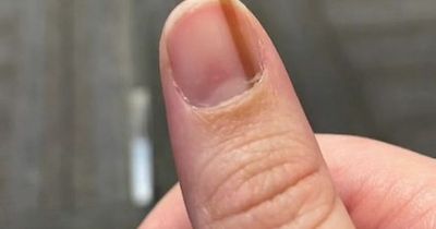 Woman stunned to discover 'cool' streak on her fingernail is life threatening