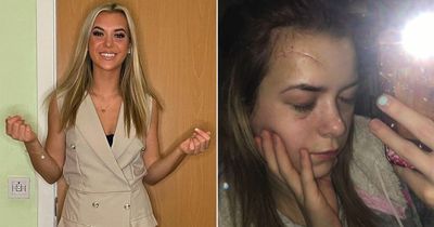 'My boyfriend left me disfigured but avoided jail - I feel so let down by the system'