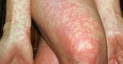 Warning for parents as scarlet fever cases rise