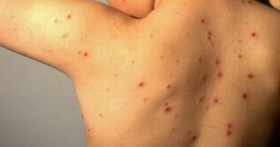 Warning to parents after rise in scarlet fever and chickenpox cases across England