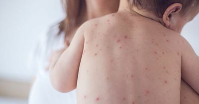 Parents warned over 'highly infectious' scarlet fever and chicken pox as cases rise
