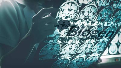 Should Biogen Investors Be Worried About Its Alzheimer's Drug?