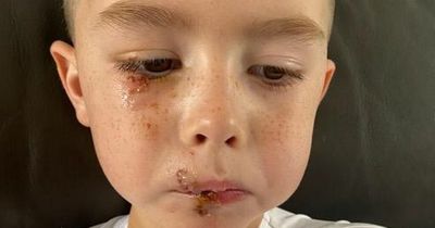 Boy, 4, savaged by neighbour's dog leaving him with horrendous facial injuries