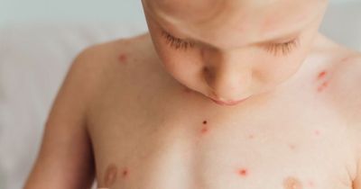 Parents urged to stay alert as chickenpox and scarlet fever cases rise