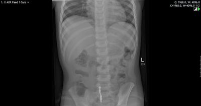 Parents warned as trend for magnets as 'fake' tongue piercings sees young people needing surgery