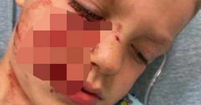 Boy's face savaged by babysitter's dog - and no one called ambulance for an hour