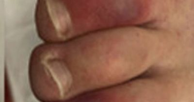 Six unusual Covid symptoms and side effects to look out for