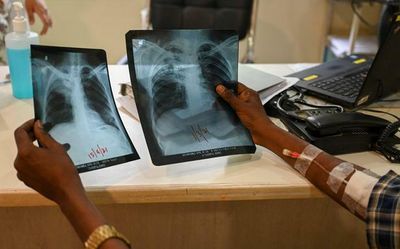 Data | How did COVID affect TB treatment in India?