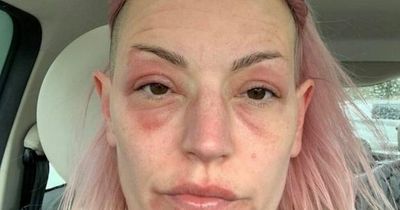 Woman claims rare reaction to booster jab left her with hives and cuts ‘ageing her 20 years in three days’