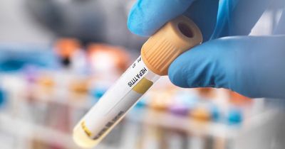 Symptoms of hepatitis to look out for as health officials investigate 74 cases in children