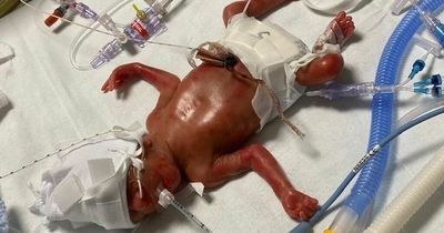 Tiny miracle baby born at 23 weeks weighed less than 1.5lbs when delivered