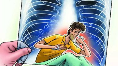 Indore on second spot in preventive programme for TB elimination in MP