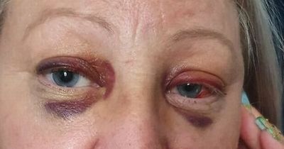 Mum left with two black eyes and smashed teeth after she was attacked at Craig David gig