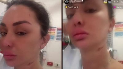 Victim of alleged acid attack in Sydney posts videos of incident on TikTok as NSW police appeal for witness