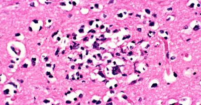 Common symptoms of Typhoid as cases of 'highly contagious' illness detected in Ireland