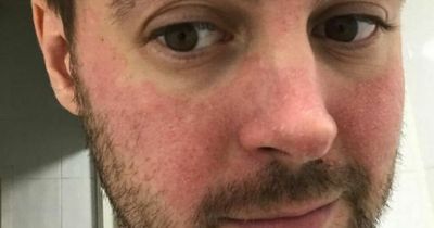 'My skin was red and blotchy for years - I found out why during lockdown'