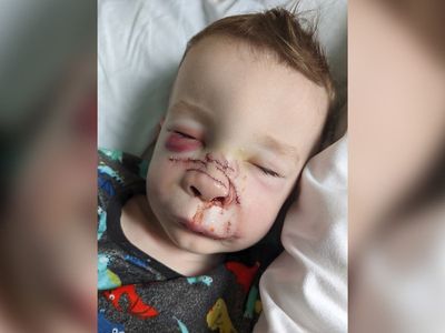 Boy, 2, suffered horrific facial injuries after dog attack by ‘best friend’ Staffordshire Bull Terrier