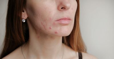 Acne treatment: The ultimate list of products you need to try