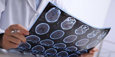 Link between Epstein-Barr virus and multiple sclerosis is a crucial discovery for people living with MS