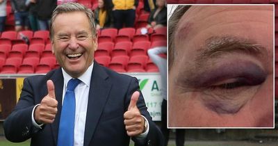 Jeff Stelling jokes he's "giving up boxing" after showing off nasty black eye