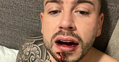 Geordie Shore star Anthony Kennedy left with broken jaw after brutal attack while on holiday