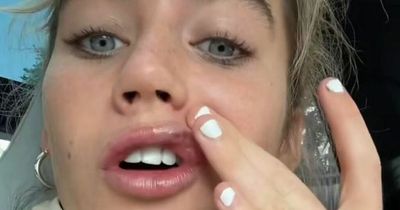 TikTok star Olivia Neill 'reinventing herself' after getting lip filler dissolved