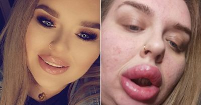 'Lip filler left me struggling to breathe and unable to talk - I was terrified'