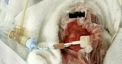 Baby born 101 days early placed in plastic bag to keep warm in hospital delivery drama