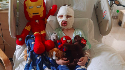 Six-year-old boy suffers third-degree burns in bullying attack: ‘Mommy they lit me on fire’