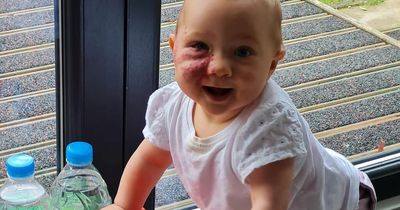 Scots baby with rare birthmark to make medical history as parents praise 'little superstar'