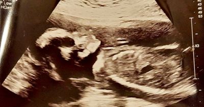 Pregnant Scots mum's shock as 'demonic skull' appears on baby scan