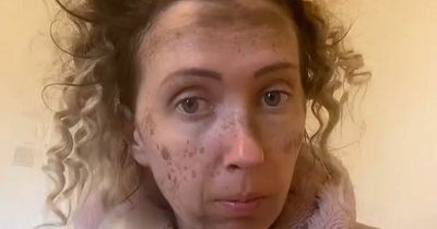 Mum's warning as fake freckle hack left her looking like she'd 'stuck head up chimney'