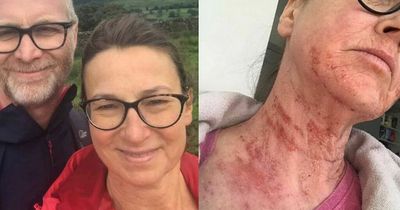 Woman says her skin 'sheds like a snake' due to steroid cream 'addiction'