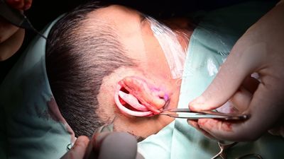 Boy’s Deformity Is Corrected With 3D-Printed Ear