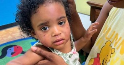 Toddler left with bloodied face after being attacked at daycare by five-year-old boy
