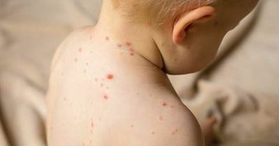 Measles symptoms to look for as 'epidemic' warning issued by World Health Organisation