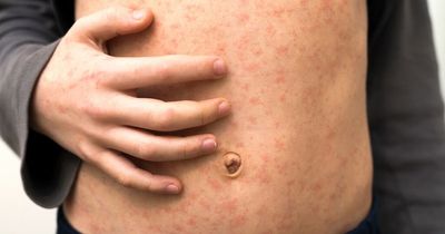 Measles an 'epidemic' as parents urged to vaccinate children from serious disease