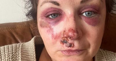 Nicola Sturgeon's sister left 'black and blue' after fall that 'could have killed her'