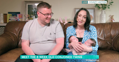 Co Antrim 'miracle' conjoined twins are one in 2.5 million