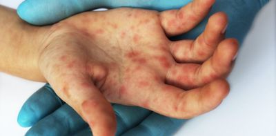Measles: global increase in cases likely driven by COVID pandemic