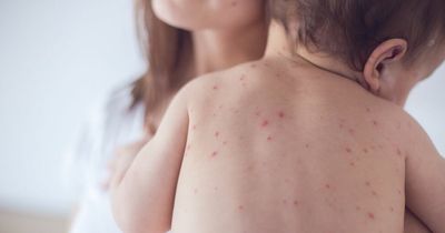 Measles symptoms parents should look out for in children as WHO issues warning