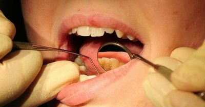 The four early warning signs of mouth cancer